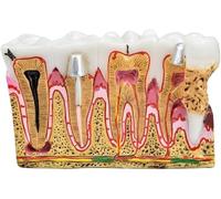 Modello Anatomico Della Carie, Modelli Di Studio Del Confronto Della Carie, Dentista Educazione All'anatomia Dentale Modello Dei Denti Modello Di Sviluppo Della Carie Dentale