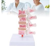 Modello anatomico della colonna vertebrale, modello dimostrativo dell'ernia discale lombare umana Durevole e modello in PVC fine per presentazioni didattiche