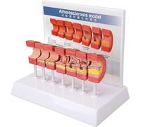Modello anatomico dell'arteria 7PCS, modello anatomico vascolare, amplificazione arterovenosa patologica, strumento didattico sul processo di trombosi aterosclerotica.