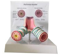 Modello anatomico dell'asma umano, modello bronchiale del sistema respiratorio