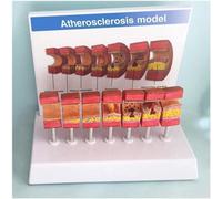 Modello anatomico di assemblaggio del trombo di aterosclerosi dell'arteria | Modello di vaso dell'arteria umana for l'insegnamento degli studi con descrizione in inglese