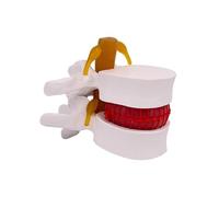 Modello Anatomico Di Ernia Del Disco Lombare, Modello Ernia Del Disco Delle Vertebre Lombari Umane A Grandezza Naturale 1,5X, Strumento Dimostrativo Della Colonna Lombare Verificato Dal Medico