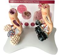 Modello anatomico di patologia polmonare normale, modello di salute alveolare del polmone umano fumatore, modello di confronto tra polmone sano e polmone patologico, modello anatomico per l'educazione