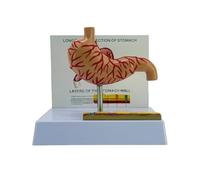 Modello anatomico di perforazione dello stomaco modello di anatomia gastrica patologica per la dimostrazione di insegnamento e simulazione educativa di perforazione gastrica