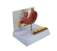 Modello anatomico di perforazione gastrica modello di anatomia dello stomaco patologico per contesti clinici Strumento di formazione del rapporto di lezione di insegnamento