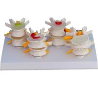 Modello Anatomico di Scheletro A 4 Stadi Vertebre Anatomiche Lombari Umane Modello Medico Degenerativo di Ernia del Disco Lombare