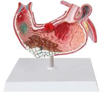 Modello Anatomico in PVC dello Stomaco, Modello di Gastrite