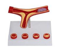 modello anatomico, Modello cardiovascolare di aterosclerosi umana, modello anatomico dei vasi sanguigni, trombo for materiale didattico medico