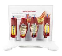 modello anatomico, Modello di blocco dei vasi sanguigni del cuore e cervello umano - anatomico dello stent corpo for ausilio didattico