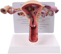 modello anatomico, Modello di patologia dell'utero femminile umano Malattia dell'ovaio