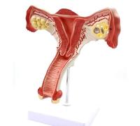 modello anatomico, Modello femminile di malattia uterina e ovarica