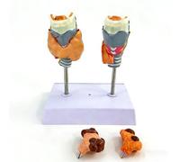 Modello Anatomico Patologico Della Tiroide Staccabile Con Base, Modello Realistico di Cisti Tumorale Della Gola Della Tiroide Umana, Materiale in PVC, Modello Della Tiroide per la Comunicazione