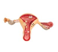 Modello anatomico patologico dell'utero, organo riproduttivo femminile a grandezza naturale con rappresentazione della malattia