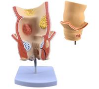 modello anatomico, Simulazione della malattia emorroidaria