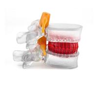 Modello Anatomico Trasparente di Ernia del Disco Lombare, Modello di Colonna Vertebrale per Medicina, Strumento Didattico 1,5 Volte le Dimensioni Reali per lo Studio dei Dischi Vertebrali Lombari