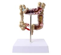 Modello anatomico umano del colon con patologie, modello di lesione colorettale umana per comunicazione medico-paziente aiuto didattico per addestramento medico.