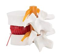 Modello anatomico umano di ernia del disco lombare, modello di ernia del disco delle vertebre lombari a grandezza naturale 1,5 volte per insegnare, apprendere e dimostrare