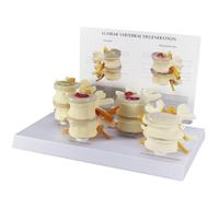 Modello comparativo di lesioni della colonna lombare in 4 stadi, modello di colonna vertebrale umana con retro in inglese, mostra ernia del disco, degenerazione ossea e discale e osteoporosi avanzata