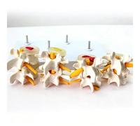 Modello Comparativo di Patologia della Colonna Lombare in 4 Stadi, Include Scheda di Istruzioni, Modello Lombare Patologico Staccabile, Materiale in PVC, Supporto Didattico Ortopedico per Studente