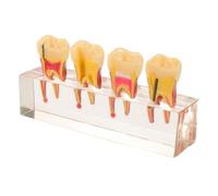 Modello da Insegnamento, Anatomia Orale Realistica | Rimovibili, Pratica Endodontica Manuale, Visualizzazione Carie, per Scuole e Aula Didattica