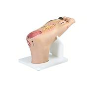 Modello del Piede Diabetico for La Formazione Infermieristica | Simulatore anatomico a grandezza naturale 1:1 con lesioni purulente, necrosi e base espositiva in acrilico(Severe)
