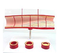Modello del Processo di Trombosi - Modello Coronarico - Materiale in PVC Modello Anatomico per L'insegnamento Umano per Gli Aiuti Educativi al Treno