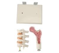 Modello della colonna vertebrale dell'osteoporosi Klatata, modello di osteoporosi anatomica ABS, visualizzazione dei cambiamenti patologici, strumento di educazione anatomia,