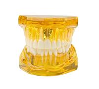 Modello dentale con parentesi graffe,Modello dente trasparente, Modello dentale impianto, Modello ortodontico dentale, demo dell'impianto con corona rimovibile/ponte per la formazione(giallo)