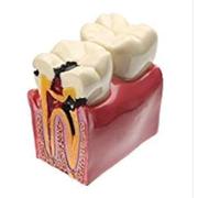 Modello dentale del dente di carie, YOUYA DENTAL Decay Denti Modello di studio comparativo 6 volte Strumenti di insegnamento del dente di carie