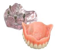 Modello dentale di protesi dentaria superiore con 4 impianti dimostrativi per l'insegnamento e lo studio