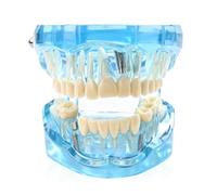 Modello dentale, modello dimostrativo, 9 x 7 x 6 cm, modello dentale con denti rimovibili, modello dentale per insegnare, modello denti malati per lezioni dentali o igiene orale, blu