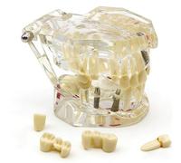 Modello dentale per l'istruzione, strumento educativo per denti rimovibili, aiuto dimostrativo anatomico per scuole dentali, modello di insegnamento della patologia per studenti