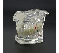 Modello Dentale Typodont Implant Restauro Dentale Patologia Dentale Insegnamento Dimostrazione Modello Simulazione (Trasparente Trasparente)