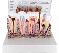 Modello di anatomia dei denti umani con problemi dentali comuni, modello anatomico dei denti for confronto tra carie, dimostrazione didattica orale dentale strumento educativo