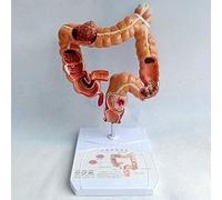 Modello di anatomia del corpo umano del colon - Strumento didattico for malattie patologiche e lesioni dell'intestino crasso