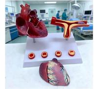 Modello di anatomia del cuore umano con bypass dell'arteria coronarica e visualizzazione di blocco dei vasi sanguigni per studio di cardiologia e insegnamento in aula