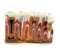 Modello di anatomia del dente della carie dentale - Studio orale e visualizzazione patologia per insegnamento completo della struttura e dell'evoluzione del dente