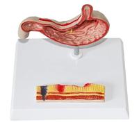 Modello di anatomia dello stomaco, modello di perforazione gastrica, modello di patologia gastrica: strumento di apprendimento for gastrite, ulcera e patologia for la formazione medica