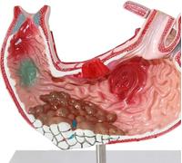 Modello di anatomia dello stomaco umano, dimostrazione di malattie gastriche patologiche, insegnamento della lesione dello stomaco con perforazione gastrica, for la ricerca medica.