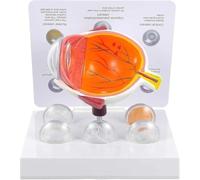 Modello di Anatomia dell'occhio Umano con Scheda esplicativa, dimostra 5 Condizioni patologiche, Strumento educativo Dettagliato per l'apprendimento scientifico e Lo Studio degli Studenti