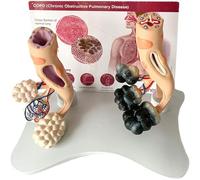 Modello di anatomia polmonare, confronto sano e patologico per l'educazione alla salute del fumo, strumento educativo anatomico per medici e pazienti