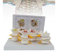 Modello di anatomia vertebrale umana a 4 stadi per l'istruzione e lo studio scientifico, struttura trasparente, include logo della scheda posteriore, ernia anatomica del disco