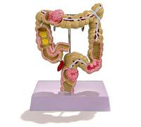 Modello di colon, modello di patologia del colon a grandezza naturale 1:1, modelli di studio anatomico dell'apparato digerente e dell'intestino crasso per la formazione medica(Small)