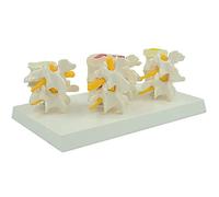 Modello Di Colonna Vertebrale A 4 Stadi Vertebre Lombari - Modello Di Colonna Vertebrale Umana - Modello Anatomico Medico Lombare - Combinazione Di Modelli Normali E Patologici Per La Visualizzazione