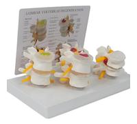 Modello di colonna vertebrale umana, colonna lombare patologica dettagliata con scheda di riferimento in inglese, ernie del disco, degenerazione ossea e del disco, osteoporosi avanzata