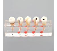 Modello di dente di restauro dentale per il trattamento endodontico, modello di studio di insegnamento della carie premolare a 5 stadi per l'istruzione e la dimostrazione dentale