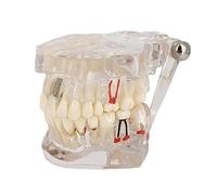 Modello di denti di malattia trasparente Denti Implantare Modello Dentista Standard Malattia Rimovibile Modello Dente