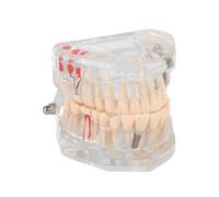Modello di denti di malattia trasparente Modello di insegnamento patologico standard dei denti rimovibili Dimostrazione Di Orali, Strumento Educativo Per Dentisti E Studenti