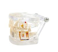 Modello di denti implantari trasparenti con rimovibile per studio dentista ufficio lezioni mediche modelli per studenti modello in resina per educazione del paziente