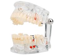 Modello di denti Kaufpart, modello di patologia sostitutiva con attrezzatura didattica per la ricerca sperimentale dentale del dente mancante